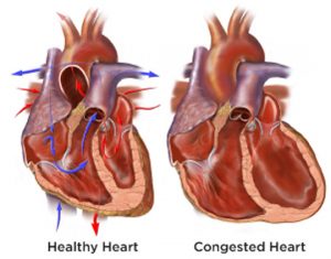 healthy heart vs congested heart