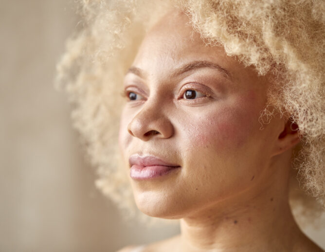 Woman with albinism
